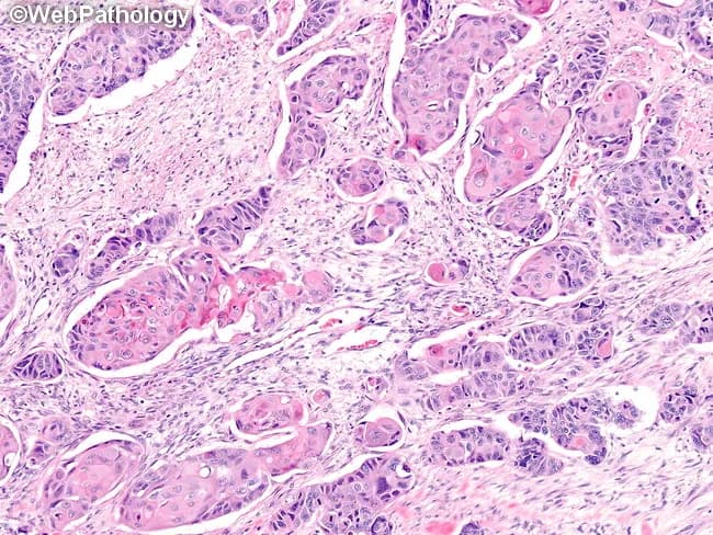 This histopathology image depicts a high-grade neuroendocrine carcinoma of the large bowel, represented by a predominantly large cell neuroendocrine carcinoma morphology with organoid (rosette-like) nests and solid sheets. The tissue shown is from the colorectal mucosa/submucosa. The stain is Hematoxylin and Eosin (H&E) on a formalin-fixed paraffin-embedded section, viewed under light microscopy. Notable features include nests of polygonal tumor cells with vesicular nuclei, salt-and-pepper chromatin, conspicuous mitotic activity, and geographic necrosis. There are areas demonstrating small cell morphology with scant cytoplasm and high nuclear-to-cytoplasmic ratio, reminiscent of SCNEC; also, foci showing glandular and squamous differentiation (adeno- and squamo-differentiated components) within the same lesion, indicating mixed histology. The architectural pattern is organoid in places, with nests separated by delicate fibrovascular stroma. The lesion invades adjacent stroma and shows considerable pleomorphism. Diagnostic significance: high-grade colorectal neuroendocrine carcinoma portends aggressive behavior, often with early metastasis; immunohistochemical confirmation (chromogranin A, synaptophysin, CD56, INSM1) is typically positive, and Ki-67 index is high. Differential diagnoses include colorectal adenocarcinoma with neuroendocrine differentiation, pure small cell colorectal carcinoma, and mixed adeno-neuroendocrine carcinoma. Clinically relevant: influences therapeutic planning toward platinum-based chemotherapy, potential surgical resection, and staging workup; important for prognosis, follow-up strategies, and research into colorectal NEC.