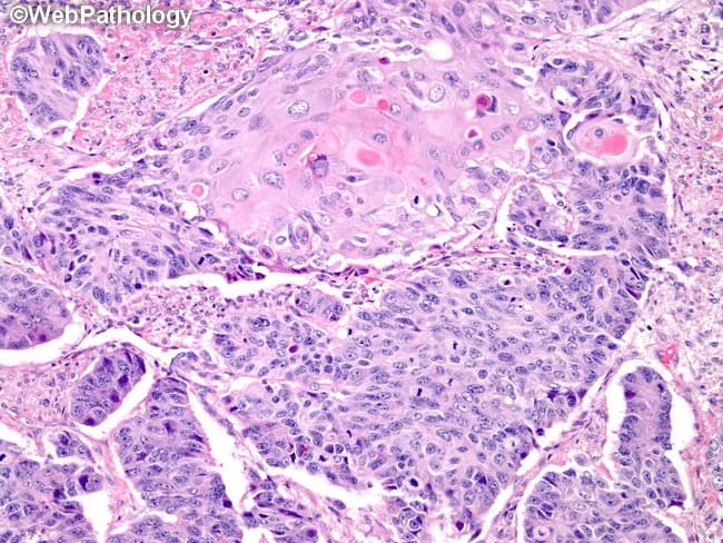 Histology using light microscopy on formalin-fixed paraffin-embedded colonic tissue stained with Hematoxylin and Eosin (H&E). The subject is a high-grade neuroendocrine carcinoma of the large bowel, large cell type, showing an organoid/nested growth pattern with solid sheets and occasional rosettes. Tumor cells are large with abundant cytoplasm and nuclei with vesicular or finely granular chromatin and conspicuous nucleoli; mitotic figures are frequent and necrosis may be present. In some foci there are glands or squamous differentiation, reflecting heterogeneous differentiation within the neoplasm. The architecture is compact, with high cellularity and minimal mucin. The background mucosa may show peritumoral inflammatory infiltrate. The histologic features are consistent with neuroendocrine carcinoma of the colon, large cell variant, which typically demonstrates high-grade cytology and aggressive behavior, and may co-express neuroendocrine markers on immunohistochemistry (not shown). The image exemplifies organoid arrangement reminiscent of pulmonary LCNEC, but arising in the colon with gastrointestinal clinical implications. Diagnostic significance includes distinguishing LCNEC from colorectal adenocarcinoma with neuroendocrine differentiation, small cell carcinoma, or MiNEN. This histology is relevant for prognosis, staging, and therapeutic decision-making, often guiding platinum-based chemotherapy regimens and comprehensive oncologic management. Correlation with imaging and biomarker profiling is recommended for accurate staging and management in practice.