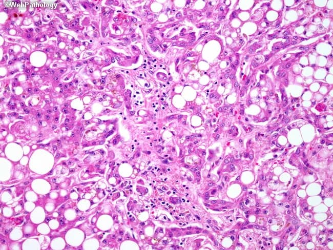 Alcoholic steatohepatitis manifested on liver biopsy as macrovesicular steatosis with hepatocellular injury, inflammatory infiltrates, and early fibrosis. This bright-field histology image, obtained from a paraffin-embedded liver biopsy and stained with Hematoxylin and Eosin, highlights lobular and portal changes. Large fat vacuoles displace hepatocyte nuclei; scattered ballooning degeneration accompanies hepatocellular damage. In the portal tracts, mixed inflammatory cells—neutrophils and lymphocytes including CD4+ and CD8+ T cells—are evident, often forming a neutrophilic infiltrate around ductular structures. A ductular reaction is visible as proliferating biliary-like cells at the limiting plate and portal-periportal interface. The surrounding parenchyma shows cytoplasmic rarefaction and mild-to-moderate inflammation, with early fibrotic bands encroaching on the portal triad region. Collectively, these features support an active alcoholic injury pattern rather than pure steatosis, differentiating from nonalcoholic fatty liver disease. Clinically, this image underpins diagnoses of alcoholic hepatitis/ASH in the appropriate history and contributes to assessments of disease activity and prognosis via fibrosis staging. It is relevant for medical education, histopathology libraries, and research on inflammatory liver diseases, fibrosis progression, and the hepatobiliary response to alcohol exposure. This image supports differential diagnosis with NAFLD, alcoholic hepatitis, DILI; useful for pathology education, case conferences, radiology-pathology correlation, and AI dataset curation, and clinical teaching.