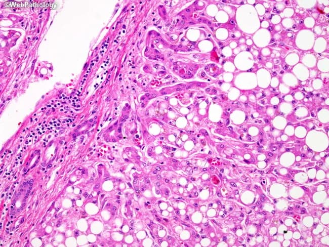 This is a histopathology slide of alcoholic steatohepatitis (ASH) in liver tissue, captured by bright-field light microscopy from a formalin-fixed biopsy. The image shows extensive macrovesicular steatosis with hepatocytes containing large fat vacuoles that displace the nucleus. Intermixed hepatocellular damage includes ballooning degeneration and cytoplasmic rarefaction. The parenchyma exhibits a mixed inflammatory infiltrate within the portal tracts and lobules, enriched by neutrophils and activated T-lymphocytes (CD4+/CD8+), consistent with alcohol-related inflammatory activity. A ductular reaction is visible at the periportal/transitional zones, indicating biliary epithelial proliferation and portal tract remodeling in response to injury. Fibrosis is present, typically pericentral or perisinular, reflecting evolving architectural distortion in chronic injury. The sample demonstrates a typical ASH spectrum: steatosis with inflammatory activity and early fibrotic changes, which differentiates from simple steatosis. Clinically, these features correlate with alcohol use disorder, elevated transaminases (AST>ALT with AST:ALT ratio >2), and higher risk of progression to cirrhosis if alcohol intake persists. This image is valuable for educational purposes in hepatology, pathology, and medical training, aiding differential diagnosis against nonalcoholic steatohepatitis (NASH), viral hepatitis, and DILI. The scale is not provided, so magnification is variable across panels; H&E staining provides cytoplasmic and nuclear detail. High clinical relevance for hepatology education.
