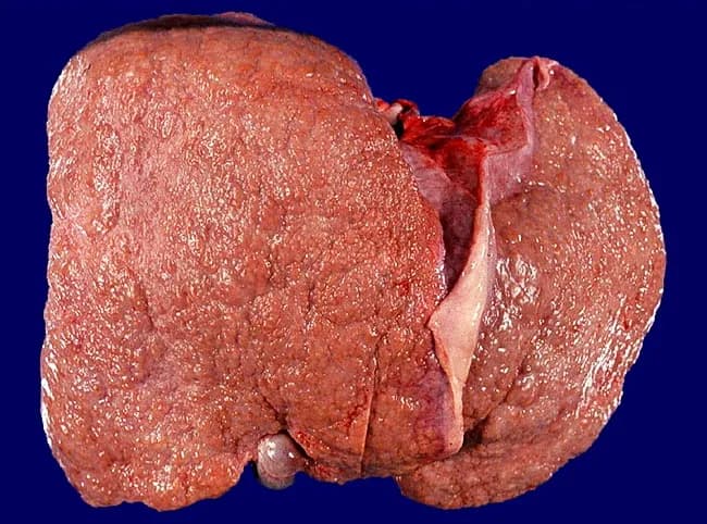 This is a gross pathology photograph of a human liver showing diffuse micronodular cirrhosis with nodules smaller than 3 mm on the surface, consistent with alcoholic liver disease. The organ appears enlarged and firm, with a coarse, irregular exterior and a nodular regenerative pattern that distorts normal lobular architecture. Coloration is mottled brownish-red, reflecting parenchymal degeneration and fibrotic remodeling; the capsule surface is intact but irregular. The microscopic correlate would reveal widespread hepatic fibrosis with fibrous septa and numerous tiny regenerative nodules; histology would show steatosis, ballooning degeneration, inflammation, and eventual cirrhotic architecture. The described micronodularity (<3 mm) indicates advanced fibrosis rather than macro-nodular cirrhosis, and underscores the progression from steatosis to steatohepatitis to cirrhosis in long-term alcohol exposure. Clinically, this morphology signals portal hypertension risk, reduced synthetic function, and potential progression to hepatic failure; timely management includes alcohol cessation, nutritional support, surveillance for varices, and evaluation for liver transplantation in end-stage disease. This image is informative for education on liver gross anatomy, correlation with histopathology, and teaching about alcohol-related liver disease staging. It is appropriate for pathology, hepatology, and radiology-pathology correlation. Note the dominant nodularity and preserved capsule, features commonly seen in alcoholic micronodular cirrhosis for teaching and research applications.