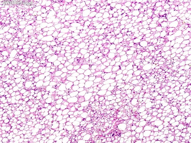 Light microscopy of a Hematoxylin and Eosin stained liver biopsy reveals marked hepatocellular steatosis. Both macrovesicular and microvesicular patterns are present: large, one-to-many fat vacuoles within hepatocytes often displacing nuclei (macrovesicular steatosis) alongside finely distributed intracellular lipid droplets (microvesicular steatosis). The steatotic hepatocytes are intermingled with inflammatory cells, consistent with steatohepatitis. Inflammation is mixed, with neutrophils and occasional lymphocytes within the lobular parenchyma, and ballooning degeneration may be evident in affected hepatocytes. In addition, focal inspissated bile plugs within small ducts indicate cholestasis, contributing to cholestatic injury. These histologic features are characteristic of drug- or nutrient-related liver injury, particularly total parenteral nutrition (TPN)-associated steatosis and cholestasis. The combined steatosis and inflammatory infiltrate reflect hepatocellular injury with altered lipid metabolism and impaired bile excretion, which may progress to fibrosis if exposure persists. Clinically, TPN-induced liver injury is associated with abnormalities in liver enzymes, hyperbilirubinemia, and potential progression to steatohepatitis if lipids are not optimized or weaned. This image is relevant for teaching and research on iatrogenic liver injury, nutritional biochemistry, pathophysiology of steatosis, and differential diagnosis including alcoholic-fatty liver disease and NAFLD. Correlation with clinical data and exclusion of other steatosis etiologies should guide management, and monitoring of liver function tests.