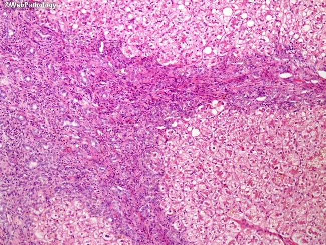 Comprehensive Description: This liver biopsy image illustrates chronic parenteral nutrition (TPN) associated liver disease with established cirrhosis. Modality is light microscopic histology with Hematoxylin and Eosin (H&E) staining. The hepatic parenchyma shows nodular arrangements demarcated by broad fibrous septa, consistent with cirrhotic remodeling. Within nodules, hepatocytes appear variably damaged, with cytoplasmic vacuolization and steatosis. Intersinusoidal and canalicular bile pigment is evident, with inspissated bile remnants filling dilated canaliculi and small ducts, indicating cholestasis. Prominent ductular reaction is present at the limiting plate and along fibrous bands, reflecting proliferative bile ductules responding to injury. The nodules are separated by fibrous bands that contain inflammatory cells and proliferating ductules, creating a characteristic irregular lobular architecture. The pattern is compatible with long-term TPN associated hepatopathy and may progress to macronodular or micronodular cirrhosis over time. Clinically, this constellation correlates with prolonged parenteral nutrition, cholestasis, and hepatocellular injury. The diagnostic significance lies in recognizing TPN associated liver fibrosis with steatosis and bile stasis, which bears risk for progressive liver dysfunction and cirrhosis. Differential diagnoses include alcoholic liver disease, nonalcoholic steatohepatitis, viral hepatitis, and biliary cholangiopathies; correlation with clinical history is essential for management. This image underscores the critical link between nutrition and hepatic structural integrity in patients.