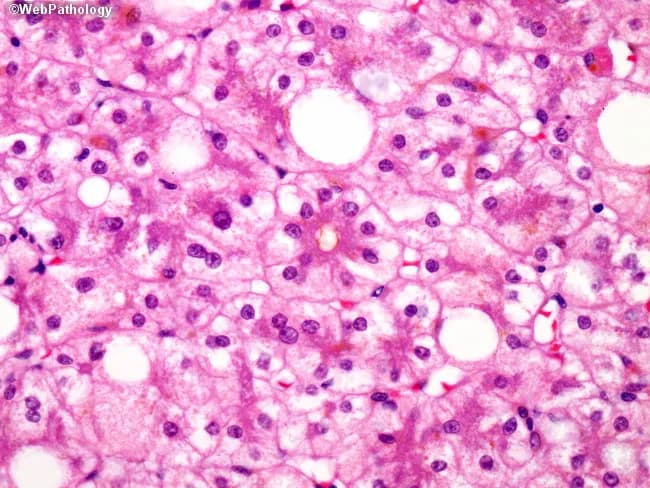 This is a liver biopsy prepared for light microscopy displaying features of parenchymal injury associated with long-term total parenteral nutrition (TPN). The hepatic parenchyma shows prominent fatty change (steatosis) with hepatocytes containing lipid vacuoles of variable size, compatible with macrovesicular and microvesicular steatosis. In addition, there is evidence of cholestasis with inspissated bile pigments accumulating within canaliculi and small intrahepatic ducts, a pattern that can mimic bile duct obstruction. The combination of steatosis and cholestatic injury is characteristic of PN-associated liver disease and can progress to ductular reaction, fibrosis, and ultimately cirrhosis if PN exposure persists. Damaged hepatocytes may display cytoplasmic ballooning and eosinophilic change, reflecting hepatocellular injury. The density of lipid droplets and bile plugs contributes to a heterogeneous lobular appearance. Clinically, this morphological spectrum mirrors the reported evolution of TPN-induced hepatic injury: steatosis in early stages, cholestasis with cholangiolar proliferation over time, and fibrotic remodeling in advanced disease. This histology is critical to distinguish PN-related liver injury from alternative etiologies such as biliary obstruction, viral hepatitis, or drug-induced cholestasis. It underscores the need for multidisciplinary management including PN modification, enteral stimulation, and monitoring of hepatic function tests to mitigate progression to cirrhosis.