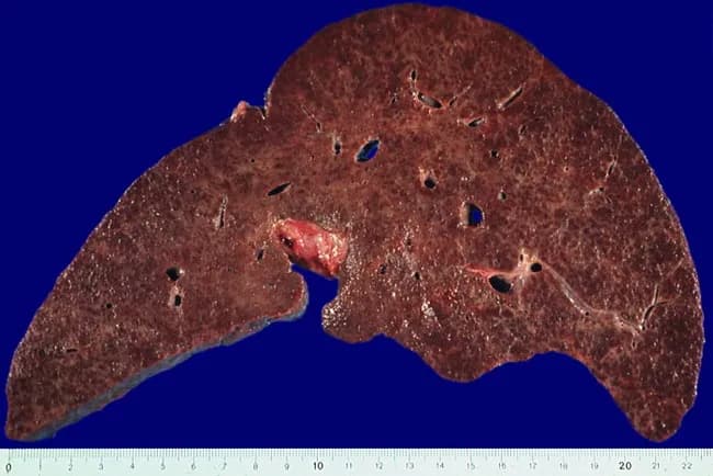 Imaging modality: Gross pathology photography of an excised liver. Specimen: whole liver with transection showing nodular surface. Anatomical location: hepatic parenchyma within the right and left lobes of the liver. The specimen demonstrates micronodular cirrhosis, a classic morphologic consequence of long-standing hereditary hemochromatosis (HFE-related), characterized by numerous small regenerative nodules that disrupt normal architecture. The color is variably brown to reddish-brown, reflecting iron deposition (siderosis) in hepatocytes and Kupffer cells; over time, periportal ferritin accumulates and parenchymal fibrosis progresses to cirrhosis with architectural remodeling and potential hepatocellular hyperplasia. The nodularity is coarse, with a nodular surface evident on gross inspection; the cut surface may show fibrous septa and regions of regenerative nodules. In hereditary hemochromatosis, iron overload begins in periportal hepatocytes and spreads to hepatocytes and bile ducts, correlating with disease stage. The clinical significance includes risk of progressive fibrosis, portal hypertension, cirrhosis, hepatocellular carcinoma, and liver failure if untreated. This image is valuable for education about genotype–phenotype correlations (classic HFE-related HH in susceptible populations), macroscopic liver pathology in iron overload, and gross-pathology correlation with histologic iron deposition. Potential clinical use cases: pathology teaching, radiologic-pathologic correlation, and comparative studies of cirrhotic nodularity.