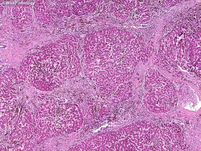 This is a liver biopsy histology image prepared with Hematoxylin and Eosin staining, viewed under brightfield microscopy at moderate to high magnification. The liver architecture shows preserved lobular arrangement but with evident iron deposition characteristic of secondary iron overload due to beta-thalassemia requiring chronic transfusions. Iron deposition is evident in both Kupffer cells (reticuloendothelial system) and hepatocytes (hepatocytic siderosis), creating conspicuously dense, variably aggregates of granular, coarse ferritin/hemosiderin pigment within cytoplasm. The portal tracts display early portal fibrosis with formation of septa bridging across lobules, consistent with progressing siderotic liver disease. Sinusoidal congestion may be present; there is no overt steatosis or ballooning change described. The staining highlights iron presence; if Prussian blue were performed, iron deposits would appear blue and confirm hemosiderosis. The observed pattern—Kupffer cell predominance early, with later hepatocytic involvement—aligns with secondary iron overload from transfusion-dependent anemia (beta-thalassemia) rather than primary hereditary hemochromatosis. Clinically, this correlates with chronic transfusion therapy and risk of fibrosis, cirrhosis, and liver dysfunction. These features underscore the diagnostic significance of hepatic iron quantification and histopathologic scoring to guide chelation therapy and monitor hepatic injury. Correlation with ferritin trends and liver function tests is essential for treatment planning.