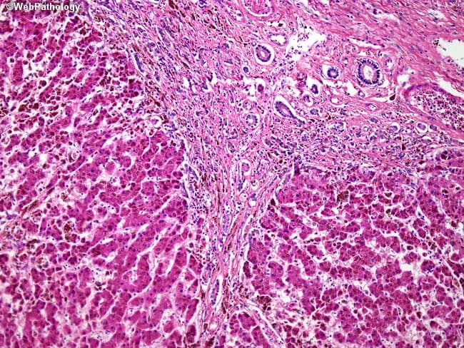 Light microscopy of a liver biopsy from a patient with beta-thalassemia–related secondary iron overload. Hematoxylin and eosin stained tissue demonstrates widespread iron deposition within hepatocytes and Kupffer cells (siderosis), evidenced by coarse brown pigments concentrated in the cytoplasm. The hepatic architecture shows portal tracts with mild-to-moderate portal fibrosis and the development of fibrous septa bridging portal regions. Within these septa, ductular proliferation is evident, indicating a ductular reaction to chronic injury. Iron deposition begins in Kupffer cells and progressively involves hepatocytes, a pattern characteristic of secondary hemochromatosis due to transfusional iron overload rather than primary hereditary iron overload. The parenchyma retains overall lobular organization but shows increasing fibrogenesis and periportal architectural remodeling. These histologic features correlate with systemic iron loading, risk of progressive fibrosis, portal hypertension, and potential progression to cirrhosis if iron chelation therapy is not optimized. Clinically, this pattern helps distinguish from primary hemochromatosis, where hepatocytes are involved earlier and Kupffer cell iron deposition is less prominent in early stages. In beta-thalassemia, management focuses on iron chelation, monitoring liver iron concentration, ferritin, and liver function, with ongoing assessment of fibrosis progression via repeat biopsy or noninvasive imaging. This image is educational for hematology–liver pathology and transplant hepatology.
