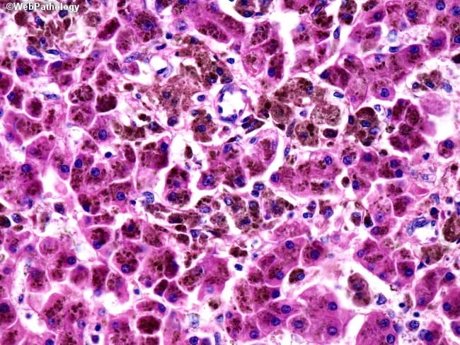 Imaging modality: light microscopy of hematoxylin and eosin stained liver biopsy section (parenchyma). The liver tissue demonstrates secondary iron overload with heavy iron deposition (siderosis) primarily within Kupffer cells and extending into adjacent hepatocytes. At high magnification, dark brown to black granular and clumped pigment is evident within the cytoplasm of macrophages and hepatocytes; the pigment corresponds to hemosiderin and appears as coarse intracellular aggregates. The overall hepatic architecture is preserved with intact lobular arrangement; eventual expansion of sinusoids may be seen in iron overload. In this specimen, the distribution begins in the reticuloendothelial system (Kupffer cells) and progressively involves parenchymal hepatocytes, consistent with secondary hemochromatosis due to exogenous iron load from chronic transfusions, hemolysis, or dialysis. The pigment is best highlighted by iron-specific staining (Prussian blue) though not shown here; ferritin and transferrin saturation may be altered clinically. Pathologic implications include potential progression to fibrosis and cirrhosis if iron deposition is sustained. Clinically, this pattern helps distinguish secondary iron overload from hereditary hemochromatosis, where hepatocyte involvement can precede Kupffer cell iron loading. The image provides educational value for hepatology, pathology, and medical training in iron metabolism, siderosis, and iron-chelation decision-making. This feature underscores the need for chelation therapy assessment.