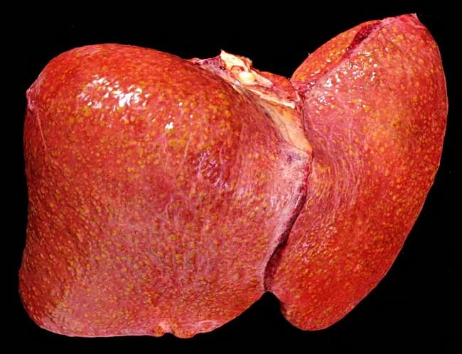 Gross pathology photograph of a human liver showing cirrhotic nodularity with coarse surface, reflecting end-stage hepatic disease. The image depicts hepatocellular nodules separated by fibrous septa, typical of chronic liver injury. In Wilson disease, impaired copper transport due to ATP7B mutation leads to copper deposition in hepatocytes, contributing to inflammation, steatosis in early disease, and progression to chronic hepatitis and cirrhosis. The macroscopic features include enlarged, nodular liver with a firm texture. While histology is not shown, cirrhosis features such as bridging fibrosis and regenerative nodules would be expected. This image serves as an educational reference for macroscopic evaluation of cirrhosis within copper storage disorders and complements histopathology with architectural assessment. Clinically significant for teaching end-stage liver disease, differential diagnosis with viral hepatitis and alcohol-related liver disease, and correlation with systemic copper accumulation; useful in pathology, hepatology, medical education, and radiology training for recognizing advanced liver damage in Wilson disease. This description highlights the relationship between macroscopic appearance and underlying pathophysiology: copper-induced hepatocellular injury triggers stellate cell activation, extracellular matrix deposition, nodularity, and eventual loss of normal lobular architecture. In practice, gross pathology complements biochemical copper quantification, hepatic copper staining (rhodanine) and ATP7B genotyping in diagnosis. The image can also aid educational case libraries and digital pathology databases for differential diagnosis training.