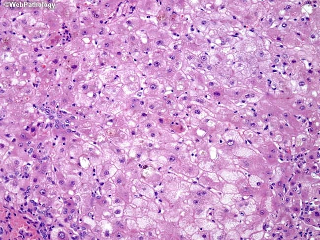 Imaging modality: light microscopy of a hematoxylin and eosin (H&E) stained liver biopsy section. The specimen demonstrates cirrhotic nodules with disrupted lobular architecture and bridging fibrosis within the hepatic parenchyma, compatible with advanced chronic liver disease. Hepatocytes display marked steatosis with macrovesicular fat and prominent ballooning degeneration, accompanied by densely eosinophilic cytoplasm. Focal cholestasis is evident, with canalicular bile and cholestatic pigment visible within affected cells. Large lipofuscin granules are scattered throughout hepatocytes, reflecting chronic oxidative injury linked to copper accumulation. Mallory bodies (Mallory‑Denk inclusions) are present in some hepatocytes, notably in the upper left field, indicating cytoskeletal damage. Collectively, these features illustrate progression from fatty change to chronic hepatitis and nodular cirrhosis in Wilson disease. The underlying etiology is copper overload due to ATP7B gene mutations causing impaired biliary copper excretion and hepatic copper deposition, with copper‑associated hepatocellular injury and oxidative stress. Diagnostic significance: when integrated with compatible serum studies (low ceruloplasmin, elevated hepatic copper) and genetic testing for ATP7B, histology supports Wilson disease diagnosis and guides management. Differential considerations include alcoholic liver disease, nonalcoholic fatty liver disease, cholestatic hepatitis, and other causes of cirrhosis. Clinical correlation with clinical presentation and copper metabolism testing is essential for accurate diagnosis and prognosis.