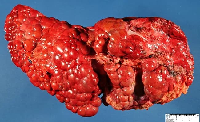Gross pathology photograph of the liver showing advanced cirrhosis with coarse, nodular surface. The specimen demonstrates macronodular cirrhosis, in which regenerative nodules exceed 3 mm in diameter, a histologic and macroscopic hallmark of fibrosis and architectural disarray associated with chronic tyrosinemia type I. The context is hereditary infantile tyrosinemia due to fumarylacetoacetate hydrolase deficiency, a metabolic liver disease that progresses to cirrhotic remodeling and risk of hepatocellular carcinoma if untreated. The hepatic nodularity and firm consistency reflect extensive parenchymal scarring with bridging fibrous septa linking nodules. Color is a deep reddish-brown, with variable areas of congested or mottled parenchyma; surface nodularity may obscure normal lobular anatomy. This image provides a macroscopic correlate to the cellular and architectural changes described in histology, including regenerative nodules embedded in dense fibrous tissue. Clinically, such findings support severe liver disease in tyrosinemia and justify monitoring for portal hypertension and hepatocellular carcinoma risk. In educational and research contexts, this photograph is valuable for teaching gross hepatic morphology, cirrhotic evolution in metabolic disorders, and the distinction between macronodular vs micronodular cirrhosis. Potential uses include medical education, pathology slide correlation, and diagnostic radiology-pathology correlation studies. These features reinforce differential considerations for cirrhosis etiologies in pediatrics worldwide today.