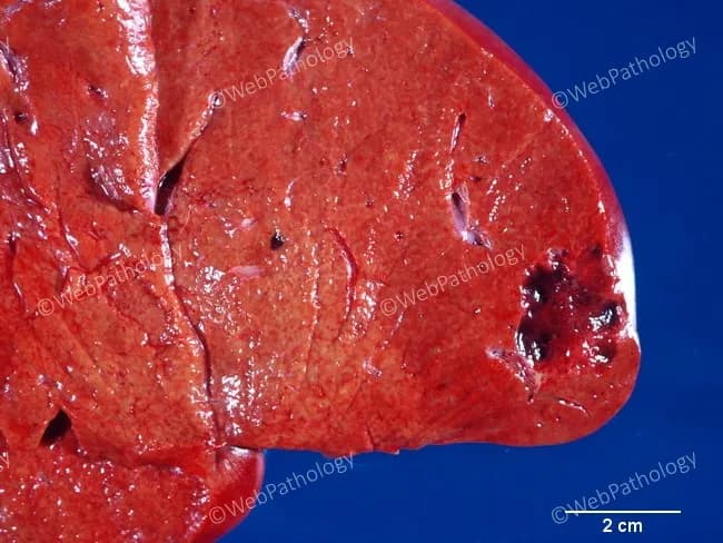Gross pathology photograph of hepatic tissue showing a solitary, well-demarcated vascular lesion at the periphery of the liver. The lesion presents as a reddish-brown, sponge-like area approximately 2 cm in greatest diameter, as indicated by the 2 cm scale bar included in the image. Surrounding liver parenchyma appears largely preserved, with intact lobular architecture and no overt necrosis. The gross features are compatible with a cavernous hepatic hemangioma, a common benign vascular tumor of the liver composed of dilated, blood-filled vascular spaces lined by endothelium with fibrous septa. The lesion's sharply defined margins and vascular character help distinguish it from other hepatic neoplasms. Clinically, hepatic hemangiomas are often asymptomatic and discovered incidentally, especially in middle-aged women; they may enlarge during pregnancy or with estrogen therapy. Radiologic correlation (ultrasound, CT, MRI) typically reveals a well-defined, enhancing lesion with peripheral nodular progression. Differential diagnoses include focal nodular hyperplasia, hepatocellular adenoma, and hepatocellular carcinoma in cases with atypical imaging features. This image is relevant for education in gross pathology, hepatic vascular tumors, and correlates with imaging and clinical features noted in standard reviews of liver lesions. Clinical management decisions hinge on lesion size, symptoms, and radiologic behavior. This image therefore serves as a teaching example for correlating gross appearance with imaging and pathology.