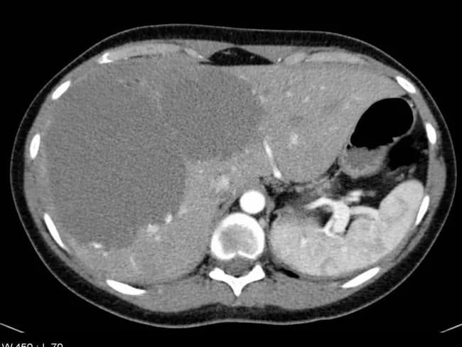 This axial abdominal CT demonstrates a solitary hepatic hemangioma in the liver. The image shown is pre-contrast (non-contrast) CT, where the lesion appears well defined and hypodense relative to the surrounding hyperdense liver parenchyma. Hemangiomas are common benign vascular liver tumors that must be distinguished from hepatic adenoma, hepatocellular carcinoma, and metastases. When contrast-enhanced CT is performed, typical behavior includes early peripheral nodular enhancement in the arterial phase with progressive centripetal fill-in during the portal venous and delayed phases; this enhancement pattern is highly characteristic. On MRI, hepatic hemangiomas usually show very high signal intensity on T2-weighted sequences and retain characteristic enhancement after gadolinium administration. Ultrasound commonly demonstrates a homogeneously hyperechoic lesion with sharp margins, reflecting internal vascular channels and slow flow. Clinically, imaging alone can often secure a confident diagnosis, avoiding biopsy due to bleeding risk from these vascular tumors. If atypical features are present or clinical suspicion remains for malignancy, additional imaging with contrast-enhanced CT, MRI with liver-specific contrast, or PET/CT can be pursued. The case from Radiopaedia (Case rID: 7014) highlights the canonical imaging appearances and reinforces the benign nature of typical liver hemangiomas, supporting radiologist confidence and appropriate patient management. This image exemplifies classic non-contrast imaging.