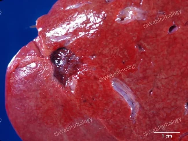 Gross pathology photography of an autopsy liver from an adult female. The image highlights a solitary hepatic lesion, most consistent with a cavernous hemangioma (benign vascular tumor). The lesion is red-brown, soft, and well circumscribed within the hepatic parenchyma. The cut surface is slightly depressed with a glistening, sponge-like appearance comprised of dilated vascular channels, as would be expected for cavernous hemangioma; no overt necrosis or calcification is evident. The scale bar at lower right indicates about 1 cm, suggesting a lesion approximately 1–1.5 cm in diameter. The surrounding liver shows otherwise preserved architecture without cirrhosis or steatosis in this view. There is no sign of invasion into adjacent structures. This incidental finding is usually asymptomatic and discovered during autopsy or imaging for unrelated reasons. Clinically, cavernous hepatic hemangiomas are the most common benign liver tumors and are typically identified by characteristic imaging features (hyperechoic on ultrasound, hypervascular on CT/MRI) but require histological confirmation if necessary. Differential considerations include focal nodular hyperplasia, hepatic adenoma, metastasis, angiosarcoma, and vascular malformations, though these are less likely given gross features. Documented here for archival pathology and educational search. Correlation with life history and imaging findings improves diagnostic confidence and educational value and practice today.