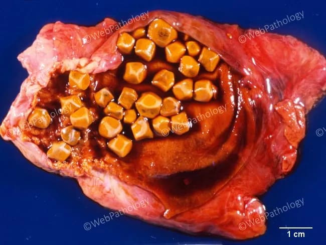 This is a gross pathology photograph of a opened gallbladder specimen displaying multiple yellow-brown cholesterol stones occupying the lumen. The modality is macroscopic pathology, not radiologic imaging, with direct visual assessment of the organ and intraluminal calculi. The primary subject is the gallbladder in the hepatobiliary system, viewed from an anterior/opened perspective to reveal the mucosal surface and stone burden. The stones are cholesterol stones, typically firm, faceted, and pale yellow, measuring several millimeters to over a centimeter in diameter, densely packed within the gallbladder. The gallbladder wall demonstrates acute inflammatory changes, including edema, hyperemia, and surrounding soft-tissue reddening consistent with acute cholecystitis; no bile ducts are visualized in this image. Clinically, such findings correlate with biliary colic symptoms, RUQ or epigastric pain, and vomiting; fever may be absent in uncomplicated cases but can accompany inflammation. The image also underscores Saint’s Triad concepts, with gallstones coexisting with diverticulosis or hiatal hernia in certain populations. Pathologic significance includes confirmation of cholelithiasis with inflammatory gallbladder changes and the consideration of surgical management by cholecystectomy to prevent recurrent attacks or complications such as biliary obstruction. This resource supports education in gross pathology, gallstone disease, and surgical pathology workflows.