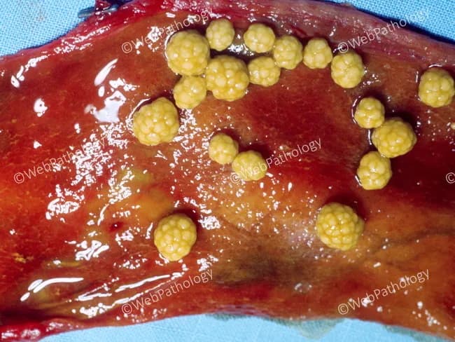 Gross pathology photograph of a gallbladder specimen opened to reveal multiple cholesterol stones. Primary subject: cholesterol gallstones, composed predominantly of cholesterol monohydrate; stones are pale yellow to golden, round to ovoid, variable in size from small to large, with a finely granular, hard exterior surface and a laminated or radiating crystalline interior. Some stones appear faceted due to growth within a confined gallbladder lumen, leading to multi-stone conglomerates that may resemble a cluster of beads. The stones are nonpigmented and not easily crushed between the thumb and index finger, in contrast to pigment stones which are softer and brittle. Exterior surfaces are smooth or slightly pitted; interior structures show crystalline lamellae and directional layering. The gallbladder mucosa may be edematous or mildly inflamed in the surrounding tissue, though the image focuses on the calculi. This gross morphology reflects cholesterol supersaturation of biliary bile, influenced by risk factors such as female sex, obesity, age, and estrogen exposure. Diagnostic significance lies in confirming cholelithiasis with cholesterol composition and helps differentiate from pigment calculus. Clinically, these stones may cause biliary colic, cholecystitis, or pancreatitis and commonly necessitate cholecystectomy. This image is well suited for educational comparison with mixed or pigment stones and for illustrating stone morphology and surgical pathology context.
