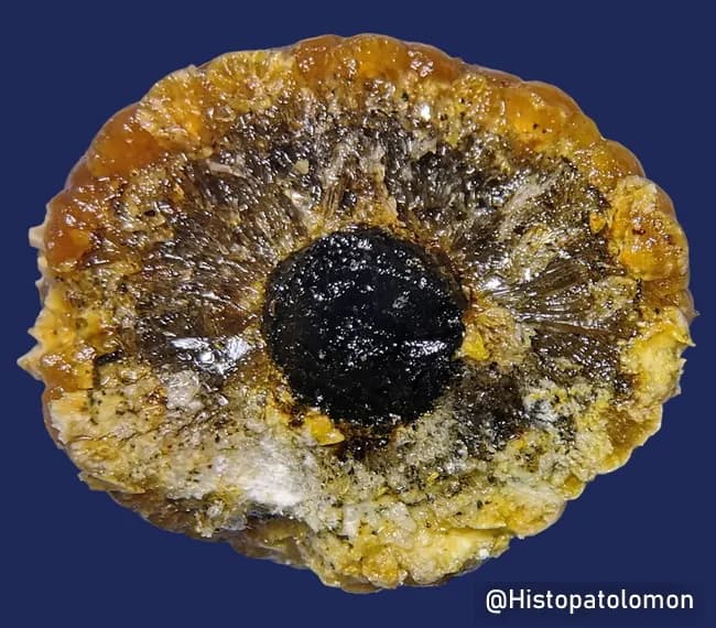 Gross pathology photograph of a cholesterol-rich gallstone in transverse cross-section, illustrating internal architecture and mineralized components. The stone displays a dense, dark central core, presumed to be bilirubin- and pigment-rich, surrounded by radiating spokes of translucent, lipid-rich material and crystallized cholesterol. The central nidus is encased by a broader, brownish to tan periphery composed of cholesterol crystals interlaced with calcific deposits. The core region contains amorphous, pigmented material with mineral admixtures such as calcium carbonate and calcium phosphate, consistent with bilirubinate pigments frequently seen in cholesterol stones. The radiating crystal scaffolding appears as linear, fan-shaped arrays extending toward the stone margin, reflecting nucleation and crystallization processes that progressively organize cholesterol monohydrate crystals. The overall morphology is multilaminar, with zones of variable density and mineral content, indicating concentric accretion during stone growth. This specimen illustrates the pathophysiology of cholesterol stones arising from supersaturation of cholesterol in bile, with nucleation on organic nidus and subsequent crystallization producing a characteristic radiating pattern. Clinically, such stones contribute to biliary obstruction and cholestasis and are a common cause of cholelithiasis; educationally, this image demonstrates composition, microstructure, and diagnostic implications for gastroenterologists and pathologists. This specimen thus serves as a reference for education, diagnosis, and research.