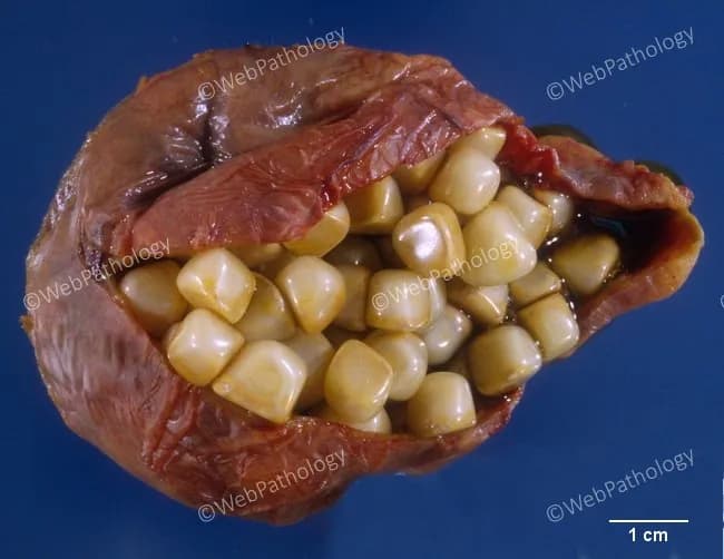 This gross pathology photograph depicts a gallbladder specimen opened to reveal intraluminal cholesterol gallstones. The organ shows a lumen densely packed with pale yellow to tan calculi, ranging from several millimeters to several centimeters in diameter. In some views a single large round stone may occupy the fundus, but more commonly there are multiple round or faceted stones that collectively fill the lumen. Faceting results from tight apposition of stones within the confined gallbladder cavity, creating polygonal, flat surfaces. The stones are cholesterol-type, typically radiolucent on imaging, composed of cholesterol monohydrate crystals with varying amounts of calcium salts, giving a smooth to slightly faceted exterior. The gallbladder wall may appear thinned or mildly contractured due to chronic distension and stone burden, though mucosal details are not always visible in this exterior view. This morphology is classic for cholelithiasis with cholesterol stones; it correlates clinically with biliary colic or chronic cholecystitis and may predispose to obstruction, pancreatitis, or cholangitis if stones migrate. For educational purposes, the image illustrates stone-stone interaction, variable stone sizes, and the spectrum from a solitary large stone to multiple stones occupying the lumen. Scale bar in the image aids size estimation, reinforcing its utility in surgical and teaching settings.