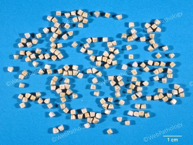 This is a gross pathology photograph illustrating multiple cholesterol gallstones recovered from the gallbladder. The stones are pale yellow to tan, faceted and rounded, arranged across a blue background with a scale bar indicating 1 cm, helping gauge lesion size. The stones appear uniform in size, consistent with a population of cholesterol monohydrate crystals that crystallized and grew concurrently within bile, producing stones of similar diameter. The overall pattern supports cholelithiasis due to cholesterol supersaturation rather than pigment or mixed stones. Their smooth, rounded surfaces suggest a chronic process with gradual calcification; the absence of pigmentation or significant radiodensity implies cholesterol stones are radiolucent on plain imaging, while they may be visible indirectly on computed tomography depending on composition. This image highlights a typical histomorphologic feature: homogeneous cholesterol composition rather than calcium bilirubinate inclusions. Clinically, such stones commonly arise in middle-aged females and individuals with obesity, rapid weight loss, or insulin resistance; they predispose to biliary colic and cholecystitis if obstructive. For educational purposes, this specimen is valuable for teaching stone morphology, size distribution, and the concept of simultaneous crystallization. It can be used in differential diagnosis exercises, radiologic-pathologic correlation discussions, and surgical planning scenarios such as cholecystectomy or gallstone management.
