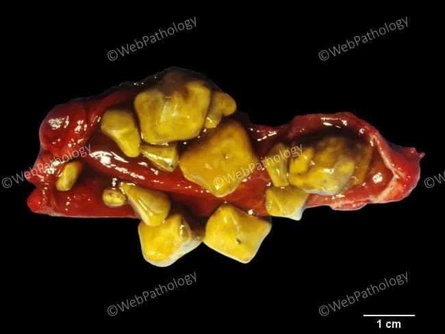 Gross-pathology photograph of gallbladder with cholesterol gallstones. Modality: macroscopic specimen photography under bright-field illumination; scale bar present showing 1 cm for size reference. Location: gallbladder lumen with multiple golden-yellow stones contiguous within a red-brown, flattened gallbladder wall. Stones are irregularly shaped, to molded contours, with smooth, glossy surfaces typical of cholesterol monohydrate composition. Size range spans approximately 2–12 mm for small fragments to larger stones; overall count exceeds a dozen in this specimen. The stones are pale to deep yellow, translucent in appearance, and demonstrate outward molding with faceted edges where they abut the gallbladder mucosa. The surrounding tissue shows minimal inflammatory changes in this specimen, consistent with chronic cholelithiasis without acute cholecystitis. Cholesterol stones arise predominantly in the gallbladder, are the most common calculus type in Western populations, and account for about 75–80% of gallstones. Composition is primarily cholesterol with variable bilirubin content and trace calcium salts. This image highlights a classic presentation: cholelithiasis caused by cholesterol supersaturation of bile; pathogenesis linked to obesity, age, female sex, rapid weight loss, and metabolic syndrome. Clinically, such stones can cause biliary colic, cholecystitis, or pancreatitis if obstructing the cystic or pancreatic duct; definitive management is cholecystectomy. This photograph is suitable for educational, diagnostic, and research contexts.