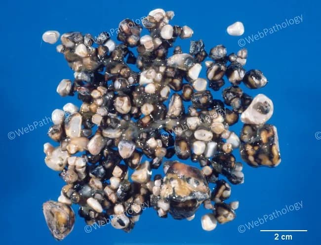 Gross pathology photograph of biliary calculi removed from the gallbladder, illustrating cholesterol-rich stones with mixed composition. The specimen consists of numerous small to medium-sized calculi arranged on a blue background with a 2 cm scale bar for size reference. The stones display a heterogeneous appearance, predominantly pale to tan with varying dark brown to black patches, and surface irregularities consistent with polycrystalline growth. Composition is reported as cholesterol monohydrate crystals interspersed with calcium bilirubinate salts, characteristic of cholesterol gallstones formed in bile supersaturated with cholesterol. Pathophysiologic drivers evident in this context include biliary cholesterol supersaturation, gallbladder hypomotility with bile stasis, nucleation of cholesterol crystals, and mucin overproduction facilitating crystal aggregation. The gross morphology, together with the described crystal content, supports a diagnosis of cholesterol cholelithiasis rather than pigment stone disease. Clinically, such stones can cause biliary colic, cholecystitis, or choledocholithiasis, and they are commonly associated with risk factors such as obesity, female sex, and advanced age. This image is relevant for educational demonstrations of stone composition and gallstone pathogenesis, and it can aid differential diagnosis, surgical planning discussions, and radiologic correlation with ultrasound or computed tomography findings that identify dependent, mixed-density calculi. Preservation and dissemination support teaching and research use.