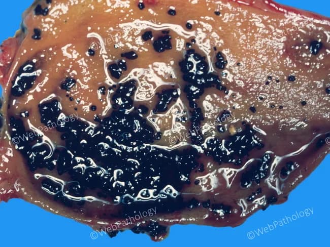 Gross pathology photograph of a gallbladder lumen containing numerous dark pigment stones. The specimen illustrates cholelithiasis with pigment-type calculi arising in the setting of chronic hemolysis. Pigment stones are rich in bilirubin calcium salts; excessive bilirubin turnover leads to supersaturation of bile with unconjugated bilirubin, promoting precipitation and stone formation. In chronic hemolytic states, conjugated bilirubin secretion increases and deconjugation within the biliary tree yields substantial deconjugated bilirubin, precipitating as black to brown pigment stones that fill the luminal cavity. The surrounding gallbladder wall may appear thickened or fibrotic in chronic inflammation, though mural details are limited in this image. The stones range from granular to angular and vary in size; their surface may be smooth or faceted and they impart a mottled, dark appearance to the lumen against a lighter mucosal backdrop. Clinically, pigment stones correlate with hemolytic anemias (e.g., sickle cell disease, hereditary spherocytosis) and can cause biliary colic or cholecystitis when obstructing cystic duct. Differential considerations include cholesterol stones, mixed pigment stones, and brown pigment stones due to infection. These findings underscore the diagnostic significance of gallbladder pigment lithiasis as a marker of bilirubin metabolism disturbances and chronic biliary disease. This image aids diagnostic and research interpretation.