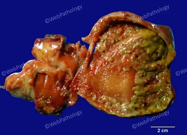 Gross pathology of a gallbladder with acute calculous cholecystitis. The specimen shows a distended, inflamed gallbladder wall with mucosal edema and erythema. The mucosa is congested and irregular, with focal necrosis and yellow-green exudate admixed with fibrinous material. Patchy greenish-yellow pseudomembranes overlying necrotic mucosa are evident, consistent with pseudomembranous cholecystitis. The serosa may be variably irritated, and adherent inflammatory adhesions can be seen along the gallbladder bed. The exterior surface demonstrates hyperemia; the wall may be thickened due to edema. A portion of the lumen is exposed, showing necrotic debris and exudate filling the lumen interface. The 2 cm scale bar provides context for dimensions; overall changes correlate with acute inflammatory insult, often precipitated by gallstone obstruction of the cystic duct. The appearance aligns with fulminant cholecystitis and may precede gangrenous transformation if infection progresses. These macroscopic findings are supported by typical histology of mucosal necrosis, neutrophilic infiltrate, edema, and fibrinous exudate on the surface. This image highlights hallmark features of pseudomembranous cholecystitis with inflammatory exudate forming pseudomembranes, mucosal ulceration, and mural necrosis within the gallbladder wall. Correlation with clinical history of gallstones, fever, RUQ pain, leukocytosis, and imaging findings reinforces diagnosis and guides emergent management for surgical intervention planning.