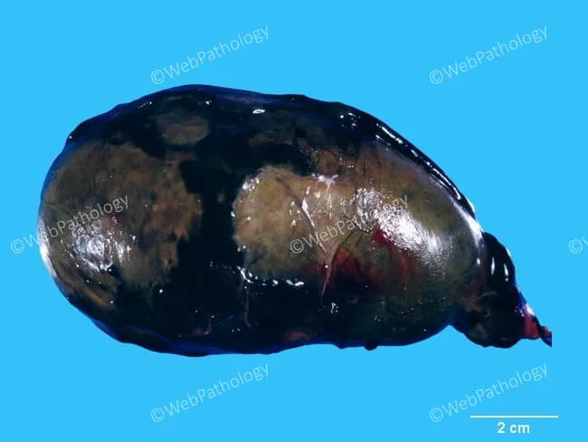 Gross pathology photograph of an excised gallbladder, captured as an external macroscopic view with a scale reference to convey size and color change. Anatomical context places this within the hepatobiliary system, the gallbladder in the right upper quadrant with wall thickening and distension typical of severe acute cholecystitis. Macroscopic features include enlargement and greenish-black discoloration, with the lumen filled by necrotic debris admixed with purulent, thick bile. The exterior may show an irregular serosal surface and subtle hemorrhagic streaks at the neck. Histologic correlation (described in accompanying notes) indicates complete mucosal and muscularis necrosis, replaced by acute inflammatory infiltrate and granulation tissue, i.e., gangrenous transformation. Pathological significance is the progression from acute inflammation to gangrene, observed in patients with diabetes mellitus, cardiovascular disease, or trauma, and is associated with a high risk of gallbladder perforation, bile collection, and sepsis. Clinically relevant implications include need for urgent cholecystectomy and broad-spectrum antibiotics; surgical pathology confirms necrosis and inflammatory sequelae. Differential considerations include emphysematous cholecystitis and acalculous or calculous cholecystitis. The image supports educational purposes in gross pathology, biliary infection, sepsis risk assessment, and prognosis determination. This depiction aids trainees in recognizing gangrenous changes and correlating gross findings with clinical staging and outcome.