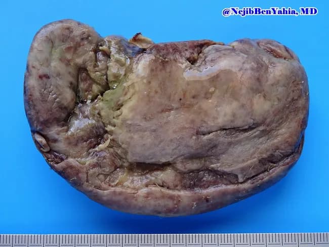 Gross pathology photograph illustrating gangrenous cholecystitis. The gallbladder is enlarged and distended, with a thickened wall and friable consistency. The serosal surface appears dull and dusky red‑brown, reflecting profound congestion and ischemia. Depressed necrotic foci are present on the mucosal and serosal surfaces, consistent with transmural necrosis typical of gallbladder gangrene. The organ shows irregular, hemorrhagic, devitalized areas interspersed with relatively preserved tissue. Exterior faces mild edema with focal surface ulcers at the fundus and body. The lumen contents are not visible in this specimen, as processing often removes bile. This macroscopic image was captured from an excised gallbladder to illustrate severe inflammatory biliary disease in surgical pathology. The blue background and centimeter scale provide reference for size and orientation. Imaging technique includes gross pathology photography, color‑calibrated macro imaging, and high‑resolution digital capture under standardized lighting. Diagnostic significance lies in confirming advanced gallbladder necrosis with gangrene, which elevates risk of perforation, peritonitis, and sepsis; it supports a clinical diagnosis of acute gangrenous cholecystitis. Educationally, this image aids recognition of gross features, correlates with clinical presentation, and enhances training in surgical pathology interpretation. This image is suitable for medical students, residents, and fellows studying gallbladder pathology, inflammatory hepatobiliary disease, and surgical specimen assessment.