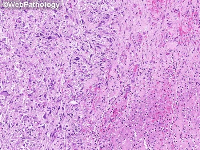 This image depicts a high-magnification light microscopy view of gallbladder wall in a case of gangrenous cholecystitis. Prepared from routine formalin-fixed paraffin-embedded tissue and stained with Hematoxylin and Eosin, the specimen is examined at high power to highlight cellular detail. In the left half, a pseudosarcomatous myofibroblastic proliferation is evident: plump spindle-shaped cells with elongated, hyperchromatic nuclei arranged in short fascicles within a loose myxoid-to-fibrous stroma, admixed inflammatory cells, and areas of necrosis consistent with gangrenous change. The right half shows more densely packed inflammatory infiltrates and vascular congestion with surrounding edema. The overall pattern can simulate a high-grade sarcoma when taken out of context, owing to marked nuclear atypia in a myofibroblastic component. Clinically, this histology corresponds to severe gallbladder inflammation with tissue destruction rather than a primary mesenchymal neoplasm. Diagnostic significance lies in recognizing a reactive, post-inflammatory pseudosarcomatous pattern to avoid overcalling sarcoma; ancillary studies, including immunohistochemistry for smooth muscle actin and desmin, and correlation with gross pathology, aid confirmation. This image is relevant for surgical pathology education, differential diagnosis of spindle cell proliferations, and radiologic-pathologic correlation in biliary disease. It informs differential diagnoses: inflammatory myofibroblastic reaction vs sarcoma; guides management.