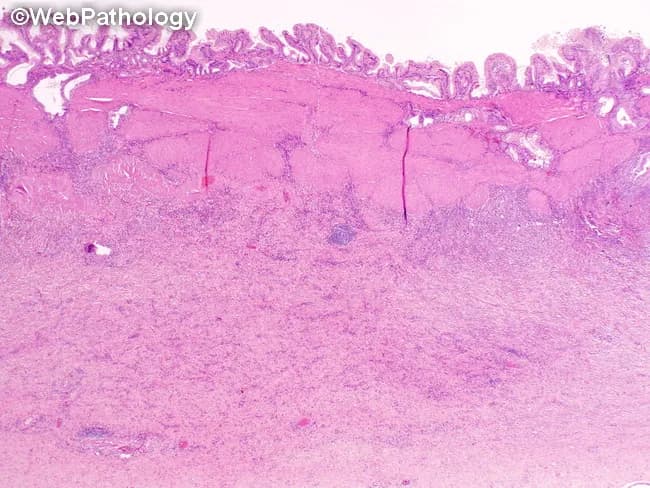 This is a low-magnification bright-field light microscopic image of gallbladder wall in chronic calculous cholecystitis, stained with Hematoxylin and Eosin (H&E). The mucosa is hyperplastic with epithelium showing mucosal metaplasia and folded mucosal ridges. The lamina propria contains a dense mononuclear inflammatory infiltrate (lymphocytes and plasma cells) that extends through the muscularis propria into the subserosa, reflecting a transmural chronic inflammatory process. The gallbladder wall is markedly thickened due to persistent inflammation and interstitial fibrosis, with loss of normal wall architecture. Rokitansky-Aschoff sinuses are evident as invaginations of mucosa through the muscularis, a hallmark of chronic cholecystitis. Pan-mural involvement with fibrotic remodeling can be seen. There may be focal areas of edema and vascular congestion without acute neutrophilic microabscesses, distinguishing this from acute cholecystitis. The image underlines the histopathologic hallmarks: chronic inflammatory infiltrate in lamina propria, fibrosis of the gallbladder wall, and Rokitansky-Aschoff sinuses; these features relate to gallstone disease and may predispose to complications such as gallbladder scarring and porcelain gallbladder in long-standing disease. Clinically, this pattern supports a history of biliary colic with chronic gallstone irritation and potentially guides surgical pathology interpretation and prognosis. This histology supports calcified and fibrotic remodeling typical of chronic inflammatory cholecystitis.