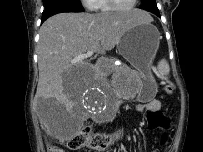 Contrast-enhanced computed tomography (CT) of the abdomen, analyzed in this coronal view, demonstrates porcelain gallbladder with calcifications in the gallbladder wall and multiple gallstones. An irregular, bulky soft-tissue mass arises from the gallbladder fossa and penetrates the adjacent hepatic parenchyma, creating an infiltrative interface with liver tissue. The mass shows heterogenous attenuation with possible focal necrosis and associated pericholecystic inflammation. There is evidence of hepatic parenchymal infiltration by the tumor, consistent with locally advanced gallbladder carcinoma. Biliary dilation is not prominently featured in this single view, but the extent of hepatic invasion indicates advanced disease. The imaging pattern - gallbladder wall calcification (porcelain gallbladder), gallstones, and an irregular mass with liver invasion - supports a diagnosis of gallbladder carcinoma arising in porcelain gallbladder. Differential considerations include chronic cholecystitis with calcification and less likely cholangiocarcinoma or metastatic disease; however, location and invasion favor primary gallbladder malignancy. Clinically, the patient presents with an abdominal mass and diffuse abdominal pain, aligning with oncologic etiology. Management implications include accurate staging to determine resectability; when feasible, radical cholecystectomy with partial hepatectomy may be curative, whereas unresectable disease requires systemic therapy and palliative care. This case highlights porcelain gallbladder as a potential malignant precursor and the necessity of surgical consultation for optimal treatment planning.