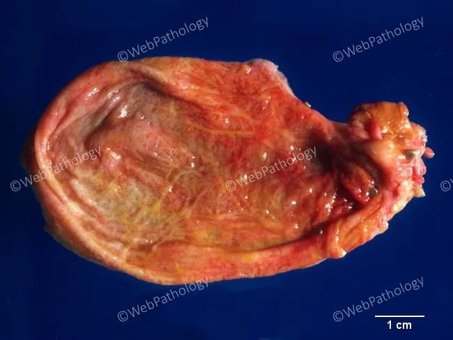 This gross pathology photograph depicts a gallbladder from a patient with chronic acalculous cholecystitis. The organ shows pronounced wall thickening with fibromuscular hypertrophy of the muscularis and expansion of intramural folds. The mucosal surface exhibits multiple Rokitansky-Aschoff sinuses, mucosal outpouchings that extend into the muscular layer, a hallmark of chronic inflammatory outflow obstruction. No radiopaque stones are evident on this exterior view, consistent with the acalculous pattern; subtle serosal vascularity and mild edema may be present. The overall texture is firm rather than edematous, reflecting chronicity. Inflammatory infiltrates are suggested by the pink-staining tissue bands and the presence of scattered inflammatory cells within the mural layers. The specimen lacks discrete calculus but displays features compatible with histologic subtypes of acalculous cholecystitis, including eosinophilic, lymphoplasmacytic, or lymphocytic predominance, as described in literature. The gross pattern aligns with clinical contexts of gallbladder outflow obstruction and chronic inflammation, providing diagnostic context for subsequent histopathology. Clinically, these findings are relevant for differential diagnoses that include chronic cholecystitis without stones, biliary dyskinesia, and inflammatory gallbladder diseases. This image is useful for education, slide correlation, and radiologic-pathologic correlation in GI pathology and hepatobiliary surgery. Correlation with histology enhances diagnostic confidence and educational value for trainees worldwide.