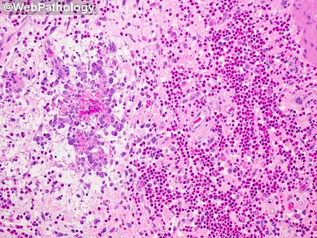 Imaging modality and technique: Light microscopy of a paraffin-embedded gallbladder mucosa section stained with Hematoxylin and Eosin (H&E). Primary subject: eosinophilic cholecystitis with destruction of Rokitansky-Aschoff sinus glands by an intense eosinophilic infiltrate. The visible lamina propria demonstrates dense clusters of eosinophils (bilobed nuclei with bright pink granules) intermixed with other inflammatory cells, accompanied by glandular distortion and gland rupture within Rokitansky-Aschoff sinuses. Mucosal damage is evident as focal erosion and edema, with disruption of normal mucosal architecture and crypt-like glands in the gallbladder mucosa. The eosinophilic inflammation drives tissue destruction, contributing to gallbladder dyskinesia and potential biliary colic. Notable features include perivascular eosinophils, tissue edema, and preservation of downstream serosa in this field, though transmural involvement may occur in advanced cases. This histology is diagnostic for eosinophilic cholecystitis, a rare inflammatory variant of cholecystitis linked to systemic eosinophilia, atopy, parasitic infection, or drug hypersensitivity. Diagnostic significance rests on recognizing eosinophil predominance and mucosal injury rather than neutrophilic invasion. Differential considerations include acute bacterial cholecystitis, chronic cholecystitis with eosinophils, parasitic inflammation, and drug-induced hypersensitivity. Clinically, correlate with peripheral eosinophil count, allergic history, and imaging findings; guide management and immunologic workup; educate pathology trainees and researchers about eosinophil-mediated biliary disease.