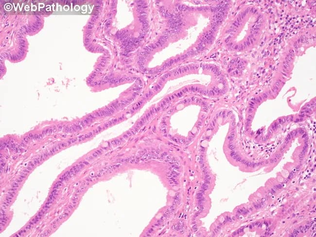 Bright-field hematoxylin and eosin stained histology slide of gallbladder mucosa demonstrating an intracholecystic papillary-tubular neoplasm (ICPN) with low‑grade dysplasia. The lesion exhibits papillary and tubular architectural complexity with mucin-producing epithelium. Epithelial cells show hyperchromatic nuclei that are mildly enlarged but largely uniform in size and shape. Nuclear polarity is maintained and the dysplastic epithelium is confined predominantly to the lower portion of the lining (basal third). Nucleoli are inconspicuous or small. Goblet cells are present, indicating intestinal-type differentiation within the ICPN. Mitotic activity is not markedly elevated. Clinical note: while this image focuses on low-grade changes, high-grade dysplasia is characterized by marked nuclear enlargement and hyperchromasia, nuclear pleomorphism, loss of polarity, prominent nucleoli, mucin depletion, and increased mitotic figures, often seen in larger lesions or extension into flat adjacent mucosa. This slide illustrates premalignant biliary neoplasia; accurate histologic grading guides surgical management and prognosis. Relevance to clinical practice includes differentiation from reactive/benign biliary mucosa and from higher‑risk lesions such as high‑grade dysplasia or invasion. Potential uses: pathology education, atlas reference, surgical pathology reporting, and research on ICPN progression. This image is suitable for teaching histologic criteria, grading challenges, and illustrating the transition from dysplasia to invasive carcinoma in gallbladder neoplasms.