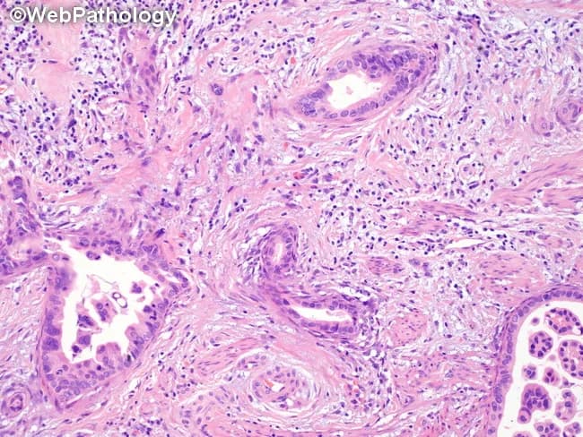 Histology: Light microscopy of a hematoxylin and eosin (H&E) stained paraffin section. Primary subject is a malignant gland-forming neoplasm with architectural glands showing round, oval, or irregular branching lumina. The neoplastic glands are lined by simple cuboidal to columnar epithelium and display features of glandular differentiation consistent with an adenocarcinoma spectrum. Invasive growth into the surrounding stroma is suggested by an irregular boundary and desmoplastic-like stromal response, though detailed invasion is not fully described in the image alone. The tumor microenvironment is notable for an inflammatory infiltrate comprising lymphocytes, plasma cells, neutrophils and eosinophils intermingled with malignant glands. Nuclear morphology of the epithelial component cannot be precisely assessed in this description, but applies typical malignant cytology. The pattern may be cribriform, tubuloacinar, or solid portions common to gland-forming carcinomas. Diagnostic significance lies in recognizing a malignant glandular neoplasm with accompanying inflammatory milieu, guiding differential diagnoses toward adenocarcinoma and its variants while excluding benign mimics. Immunohistochemistry and clinical correlation are essential to determine primary site and origin. Practical relevance includes educational illustration of glandular malignancy, pathology archives, and diagnostic consultation; aids in tumor grading, staging, and therapeutic decision-making where glandular cancers are suspected. Further study with additional stains would enhance specificity.