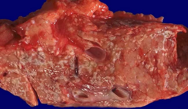 Gross pathology photograph of pancreatic tissue from a patient with acute necrotizing pancreatitis. Modality: gross pathology photography; specimen: pancreatic parenchyma with diffuse stippled necrosis and extensive peripancreatic fat necrosis. The pancreas exhibits mottled tan-brown necrotic areas intermingled with hemorrhagic streaks; focal liquefactive zones; peripancreatic adipose tissue is disrupted with edema and necrosis. The cut surface reveals areas of tissue loss with friable texture and scattered liquefactive debris; pancreatic lobules appear irregular with necrotic debris; small ducts may contain necrotic material. Peripancreatic fat shows chalky fat necrosis with saponification. Overall appearance is consistent with necrotizing pancreatitis (pancreatonecrosis). Notable features include diffuse necrosis within pancreatic parenchyma and surrounding fat, lack of a discrete capsule, and vascular congestion in affected regions. Diagnostic significance: confirms necrotizing pancreatitis and indicates severe disease burden; correlates with risk of infection, sepsis, and progression to walled-off necrosis if untreated. Differential considerations: hemorrhagic pancreatitis, sterile pancreatic necrosis, proliferative fat necrosis, pancreatitic fat necrosis (redundant). Clinical correlation: supports surgical planning for debridement or step-up therapy; prognostic implication relates to extent of necrosis and organ failure; this morphology is essential for education and research. It highlights necrotic pancreatic tissue and surrounding fat as targets for therapeutic intervention and intraoperative planning purposes.