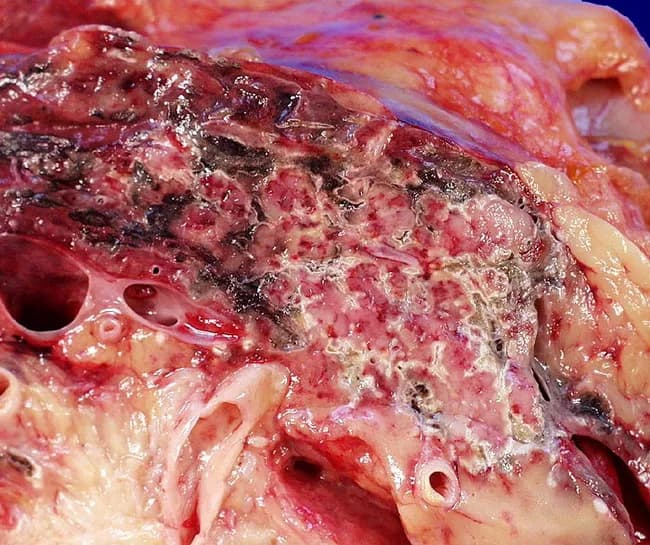 Gross pathology photograph of a resected or opened pancreatic specimen showing extensive necrosis consistent with acute necrotizing pancreatitis. The tissue demonstrates hemorrhagic, black brown necrosis of the pancreatic parenchyma with overlying peripancreatic fat appearing yellow to pale and interspersed with dark, necrotic foci. The surface is mottled with irregular areas of necrosis and hemorrhage; surrounding adipose tissue is edematous and partially necrotic, with fat saponification visible as soft, friable material. There may be scattered clearing holes from tissue removal and ducts and vascular structures are exposed. The specimen’s color variation ranges from pale pink to grayish and dark brown, indicating a spectrum from acute inflammation to liquefactive necrosis. The clinical history includes prior acute cholecystitis and cholelithiasis, consistent with gallstone pancreatitis as the etiologic context. The image underscores severe pancreatic injury with necrosis extending into peripancreatic fat, a hallmark of necrotizing pancreatitis. This finding has significant diagnostic implications, implying SMS severity, risk of systemic inflammatory response, infection, and potential need for debridement, necrosectomy, or staged intervention. In educational settings, this image illustrates the macroscopic appearance of pancreatic necrosis and peripancreatic fat necrosis in the course of gallstone-related pancreatitis. Pathology relevance includes correlative clinical and radiologic assessment. Educational value for residents and fellows.