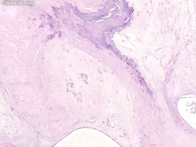 Imaging modality: Histopathology (Light Microscopy) after Hematoxylin and Eosin staining of breast tissue. Anatomical location: Breast tissue, mammary gland stroma; central region shows clusters of cysts separated by dense fibrous stroma. The collagenized stroma forms a stellate scar-like configuration with radiating fibrous septa extending into surrounding parenchyma. Dystrophic calcifications are present within the stromal matrix between cystic spaces and the scar, appearing as granular basophilic deposits. The epithelial component lining ducts within cysts is minimal and lacks cytologic atypia; occasional sclerosing adenosis-like features may be seen; overall architecture resembles complex sclerosing lesion or radial scar. Notable features: calcified stromal dystrophy, stellate radiating architecture, benign-appearing ductal epithelium; absence of significant pleomorphism or mitotic activity. Diagnostic significance: benign fibrocystic-related radial scar-like lesion; on imaging, such patterns may mimic carcinoma, necessitating complete excisional biopsy or careful margin assessment; differential diagnosis includes papillary lesions, fibroadenoma with sclerosis, and invasive carcinoma with desmoplasia. Clinical correlation: in asymptomatic patients, correlate with imaging findings; may be incidental; in patients with calcifications or a palpable mass, correlate with radiology to determine need for excision. Potential clinical use cases: teaching histology of breast lesions, correlating radiologic-pathologic findings, evaluating sclerosing breast lesions in diagnosis and surgical planning.