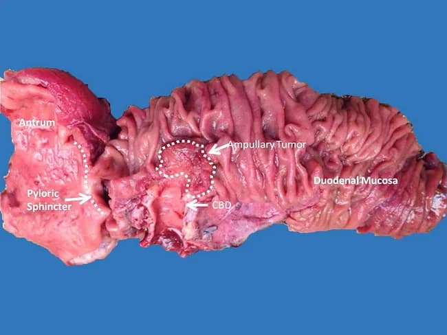 This is a macroscopic photograph of a freshly dissected pancreaticoduodenectomy (Whipple) specimen illustrating an ampullary carcinoma at the ampulla of Vater. The resected tissue includes the duodenum with its mucosa, the common bile duct (CBD), the pancreatic head region, and the surrounding periampullary structures. The labeled structures in the image identify the Antrum and pyloric sphincter on the proximal stomach side, the CBD as a tubular channel, and the ampullary tumor located at the major duodenal papilla. The tumor appears as a nodular, irregular lesion at the ampullary region, with tumor margins that abut the surrounding duodenal mucosa and biliary tract. Although imaging studies such as computed tomography (CT) and endoscopic ultrasound (EUS) are used preoperatively, the lesion itself may be occult on routine imaging and definitive assessment relies on histopathology of cytologic material, endoscopic biopsy, or transduodenal sampling. The Whipple procedure remains the standard surgical management for invasive ampullary carcinoma due to complex regional anatomy and the need for en bloc resection of the pancreatic head, duodenum, bile duct, and often part of the stomach. In noninvasive or limited disease, transduodenal resection may be considered. Image courtesy of Dr. Terri Crook, Dallas, Texas, for educational and diagnostic illustration.