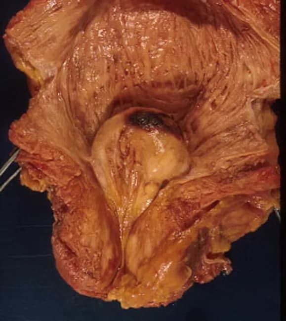 Gross pathology photograph of an autopsy prostate demonstrating benign prostatic hyperplasia with median lobe enlargement. The image captures in situ tissue within the pelvic cavity, with the enlarged median lobe protruding into the bladder neck and producing a ball-valve type obstruction of the prostatic urethra. The prostatic tissue is tan to yellow-brown, with nodular surfaces and a heterogeneous but non-neoplastic appearance consistent with nodular hyperplasia. The bladder neck region appears narrowed by the midline lobulation, while surrounding adenomatous prostatic tissue maintains identifiable lobular architecture. This specimen illustrates the anatomic basis of lower urinary tract symptoms in aging men, including urinary hesitancy, weak stream, and nocturia, attributable to outlet obstruction caused by BPH. The description emphasizes the median lobe as a dominant contributor to obstructive physiology and demonstrates how intravesical protrusion can impede urine flow. While autopsy findings may not reflect functional dynamics in vivo, they correlate with clinical presentations and surgical targets such as monopolar or holmium laser prostatectomy. Educational relevance includes urology, anatomy, pathology, and radiology correlation, providing a tangible example of bladder outlet obstruction mechanisms and the relationship between prostatic zones and the bladder. Useful for teaching, case review, and surgical planning.