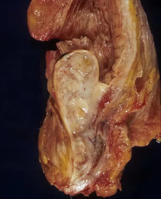 Gross pathology photograph of an autopsy prostatic specimen demonstrating benign prostatic hyperplasia with median lobe enlargement projecting into the bladder neck. The tissue appears tan‑brown and nodular, with a prominent midline lobe extending anteriorly toward the bladder outlet and creating a ball‑valve type obstruction at the bladder neck. The surrounding capsule and adjacent prostatic zones show variable, fibromuscular hyperplasia consistent with nodular hyperplasia rather than malignant invasion. This gross appearance reproduces the classic mechanism of lower urinary tract symptoms in aging men: progressive prostatic enlargement compresses the urethral channel, especially at the bladder outlet, producing obstructive and irritative voiding disorders. The autopsy context confirms a non‑malignant process, though histology would be required to definitively exclude focal carcinoma. Notable features include bilateral symmetry of nodular growth and conspicuous midline protrusion, which can be associated with reduced urinary flow, incomplete emptying, and increased postvoid residuals. Clinically, these findings underpin diagnostic considerations such as benign prostatic hyperplasia and differential diagnoses including prostatic adenocarcinoma or prostatitis; radiologic or endoscopic correlation may help stage obstruction. Educationally, this image serves as a reference for urology trainees and pathology learners to understand gross anatomy, angioarchitecture, and the anatomic basis of bladder outlet obstruction in BPH.