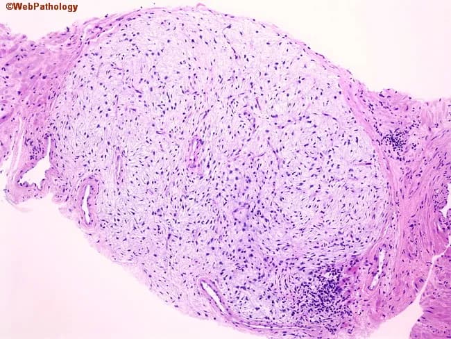 Light microscopy image of prostatic tissue stained with Hematoxylin and Eosin (H&E). The slide displays a well-circumscribed nodule composed of loose, fibromuscular stroma with sparse cellularity, representing an early stromal component of benign prostatic hyperplasia (BPH). Epithelial elements are scant within the nodule, with little glandular proliferation, and the surrounding prostate parenchyma shows a conventional fibromuscular stroma adjacent to residual glands. The stromal cells are spindle-shaped with elongated nuclei and pale cytoplasm embedded in a myxoid to fibrous extracellular matrix; mitotic activity is absent or minimal. There is no cytologic atypia, necrosis, or significant inflammatory infiltrate. This pure stromal nodularity represents one of the earliest histologic changes in BPH and can be encountered incidentally on prostate needle biopsies. Importantly, the diagnosis of prostatic hyperplasia (or nodular hyperplasia) should not be rendered on needle core biopsy; rather, specimens should be signed out as benign prostatic tissue with descriptive comment on the nodular stroma. Clinically, such findings may correlate with lower urinary tract symptoms in the patient, but histology alone cannot confirm severity. The differential considerations include stromal-rich lesions or scar tissue; malignant prostatic neoplasia is not suggested by these features. This pattern emphasizes strict sign-out criteria.