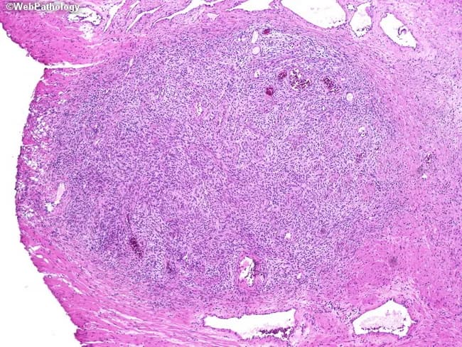 This is a histopathology slide of prostatic tissue obtained from transurethral resection of the prostate (TURP). Imaging modality: light microscopy; staining: hematoxylin and eosin. The specimen demonstrates nodular stromal hyperplasia composed of irregularly sized acini intimately admixed with dense fibromuscular stroma. The nodules display papillary infolding and variable gland size, a hallmark of nodular prostatic hyperplasia (benign prostatic hyperplasia, BPH). The glandular epithelium is typically cuboidal to columnar without significant cytologic atypia; stromal cells are fibromuscular and nonmalignant. Overall architecture is nodular with coarse borders and occasional dilated acini, consistent with benign prostatic tissue arranged in nodules rather than a uniform adenocarcinoma. No malignant features are identified: mitotic activity is not increased, and there is no prominent necrosis or invasion. In TURP specimens, the diagnostic focus rests on obstructive voiding symptoms and clinical presentation rather than morphologic abnormalities. The findings correlate with lower urinary tract symptoms due to prostatic enlargement and bladder outlet obstruction; they support a benign etiology for LUTS and guide management toward medical therapy or TURP as required. Important differentials include prostatic adenocarcinoma, prostatitis, and atrophy; however, absence of invasion or significant atypia favors benign nodular hyperplasia. Correlation with clinical history and imaging enhances diagnostic confidence overall.