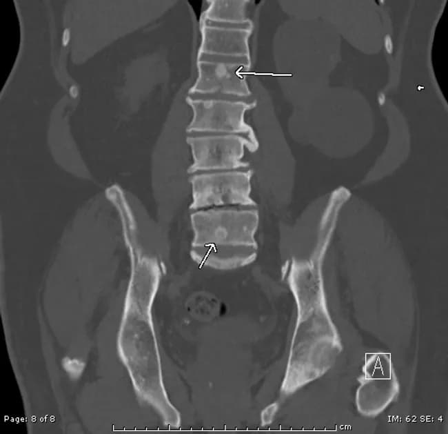 Computed tomography (CT) scan of the pelvis and lower spine performed in a coronal plane with bone-window technique demonstrates multiple osteoblastic, sclerotic lesions involving the sacrum and contiguous lumbar vertebrae. In this patient with a history of prostatic adenocarcinoma (Gleason score 5+4=9), the image highlights densely radiopaque foci along the sacral alae and across the L1–L5 pedicles and endplates, with subtle vertical striations and preserved cortical margins. The pattern is classic for hematogenous, prostatic metastasis to bone, producing reactive sclerosis and meshwork coalescence within the vertebral bodies. No obvious large lytic destruction or acute fracture is seen on the current study, though mild endplate irregularity at the sacral junction is present. The arrows bracket the most conspicuous metastases, illustrating pelvic ring involvement and axial skeleton dissemination. This radiologic finding has significant clinical implications: confirms metastatic disease, supports staging in patients with prostate cancer, influences therapeutic planning (androgen deprivation therapy, hormonal therapy, chemotherapy, radiopharmaceuticals), and serves as a baseline to monitor response or progression during systemic treatment. Clinically, correlation with PSA levels, prior imaging, and treatment history is essential to distinguish progression from treatment response and to guide follow-up imaging strategies. Correlation with symptoms and systemic biomarkers improves patient-specific management plans.