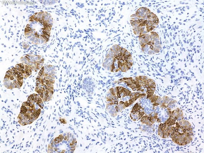 This histopathology slide depicts a formalin-fixed, paraffin-embedded prostatic needle biopsy specimen subjected to immunohistochemical staining. The tissue showcases prostatic glandular units with a preserved, continuous basal cell layer; gland lumina are variably sized and lined by two cell layers in many foci. The basal cell population exhibits diffuse, strong positivity for high molecular weight cytokeratin (HMWCK) with a brown chromogen, outlining the acinar architecture. Adjacent stromal and epithelial cells show non-specific blue hematoxylin counterstain. The staining pattern contrasts with adenocarcinoma, where the basal layer is typically disrupted or absent; here, the intact basal cell layer argues against neoplastic invasion and favors basal cell hyperplasia. p63 immunoreactivity is present in basal cells, reinforcing benign histology. In differential, prostatic hyperplasia with epithelial budding may mimic carcinoma on H&E, but the IHC demonstrates basal cells per gland. Clinically relevant use: helps distinguish benign prostatic hyperplasia with basal cell hyperplasia from prostatic adenocarcinoma in suspicious needle biopsy cores, reducing overtreatment and guiding management. The image demonstrates an educational example of diagnostic IHC utility, where basal cell markers are essential in challenging cases. The technique is commonly employed in uropathology practice to confirm benign versus malignant prostatic lesions. Correlation with morphology improves diagnostic confidence significantly.