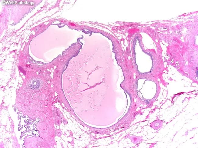 Imaging modality: Histopathology (light microscopy) of a bladder dome/anterior wall biopsy with urachal remnant. In this section, a cystically dilated luminal space is seen embedded in a thin fibromuscular stroma. The cyst is lined by epithelium that may resemble urothelium, be flattened and atrophic, or display glandular (enteric-type) differentiation. The mucosa is variably thinned with focal cuboidal-to-columnar lining, and the surrounding wall consists of a delicate fibromuscular capsule without invasion by neoplastic tissue. The midline, extravesical location supports urachal origin, and there is no overt inflammatory destructive process evident. Normal bladder mucosa above and around the lesion is unremarkable. The architecture, epithelium, and stromal configuration are characteristic of a urachal remnant or urachal cyst rather than a malignant neoplasm. Clinically, this finding is important to distinguish benign urachal remnants from urachal carcinoma and other cystic bladder lesions, since management and prognosis differ markedly. Differential diagnoses include bladder diverticulum, cystitis cystica/glandularis, and enteric metaplasia. Pathologic recognition informs clinical correlation, imaging review, and surveillance strategies. This entity, commonly asymptomatic or presenting with recurrent infections, carries a favorable prognosis when confined to the urachal tract and without invasive features on histology. Correlative imaging and clinical data reinforce benign interpretation and help guide follow-up.