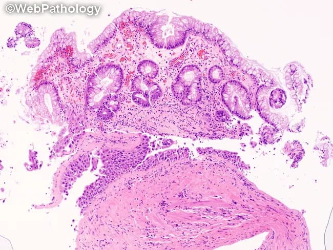 Histopathology (light microscopy) of bladder diverticulum mucosa in H&E-stained sections, with two fragmentary regions illustrating distinct epithelial phenotypes. The lower fragment demonstrates urothelial carcinoma in situ (CIS): full-thickness high-grade urothelial dysplasia with marked nuclear enlargement, pleomorphism, hyperchromasia, loss of polarity, and increased mitotic activity, while the basement membrane remains intact, indicating non-invasive disease. The surrounding stroma shows preserved lamina propria without invasion. The upper fragment reveals intestinal metaplasia within the urothelium, characterized by intestinal-type columnar epithelium with goblet cells and mucin-producing cells; this metaplastic epithelium is discontinuous from the CIS and sites of goblet cell formation are evident. Together, these findings indicate divergent differentiation within the same diverticular mucosa: flat CIS coexisting with intestinal metaplasia. Clinically relevant interpretation includes the diagnosis of high-grade non-muscle-invasive urothelial carcinoma confined to the mucosa (CIS) and associated metaplastic change, a potential premalignant/metaplastic process that can complicate histologic interpretation and influence risk stratification. Diagnostic significance: CIS confers high risk for progression to muscle-invasive disease; management considerations include intravesical therapy (BCG) or cystoscopic surveillance with repeat sampling; intestinal metaplasia may predispose to glandular neoplasia and warrants careful follow-up. This composite histology underscores the need for meticulous sampling of bladder diverticula and adjunct immunohistochemistry in equivocal cases.