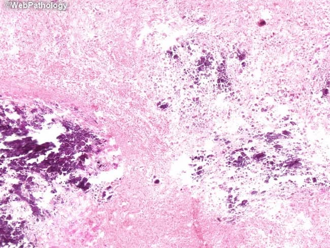 This is a histopathology slide of urinary bladder mucosa examined under light microscopy following hematoxylin and eosin staining. The primary subject is encrusted cystitis with deposition of calcium salts in the lamina propria of the bladder wall, consistent with infection by urease-splitting bacteria (e.g., Proteus mirabilis) that alkalinize urine and promote mineral precipitation on injured urothelium. The lamina propria contains scattered calcifications appearing as dark, basophilic deposits dispersed throughout the connective tissue matrix, often accompanied by a mixed inflammatory infiltrate and focal erosions of the urothelial surface. The urothelium may show reactive changes with papillary or irregular architecture, while the submucosa demonstrates edema and mild fibrosis in areas of chronicity. Calcific encrustations are multifocal and not limited to a discrete lesion, giving a 'salt-and-pepper' appearance on higher magnification. Clinically, encrusted cystitis signals a chronic bacterial infection with alkaline urine, requiring targeted antibiotics and correction of the underlying infectious milieu. The observed histology supports infection-driven mineralization rather than primary neoplastic processes. This image is relevant for educational scenarios addressing urinary tract infections, urease-producing bacteria, pathology of bladder mucosa, differential diagnosis with calcified cystitis and malakoplakia, and radiologic-pathologic correlation. Correlate with urine pH measurements and urease-positive bacterial cultures for targeted therapeutic planning.