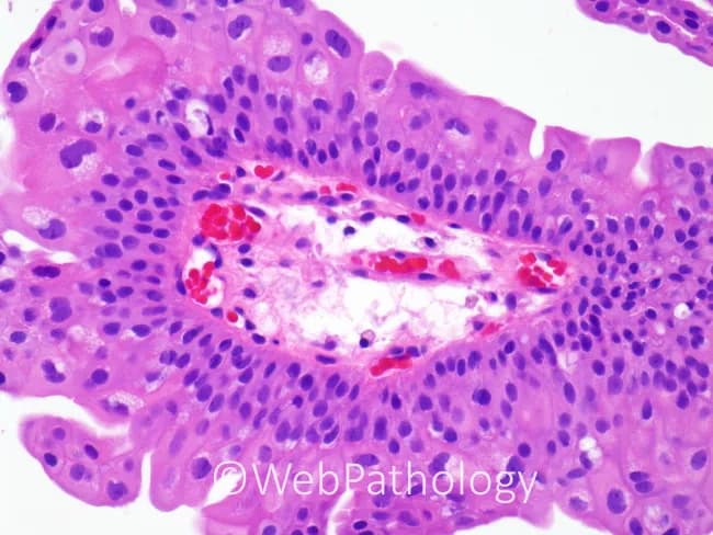 This is a hematoxylin and eosin stained histopathology micrograph of oral mucosa epithelium with underlying connective tissue (buccal/oral mucosa). Light microscopy reveals a stratified squamous epithelial layer with orderly cellular architecture and a preserved basement membrane. The surface epithelium shows uniform basal and parabasal cells, relatively normal cytoplasmic maturation, and no overt dysplasia or malignant epithelial proliferation. In the lamina propria, there is a mild inflammatory infiltrate consisting of lymphocytes and plasma cells, accompanied by scattered neutrophils and increased vascularity with dilated capillaries. The subepithelial stroma appears edematous but without frank ulceration. Red blood cells are visible within small vascular channels in the superficial lamina propria. Overall, the image demonstrates a benign inflammatory mucosal process with vascular congestion rather than neoplastic transformation. Clinically, these findings are compatible with acute or chronic mucositis, reactive/traumatic irritation, or mild infectious mucosal inflammation, depending on clinical context. Diagnostic significance lies in ruling out dysplasia or carcinoma in situ within this tissue plane and guiding management toward conservative therapy and etiologic assessment. This image is well-suited for educational purposes in histology, oral pathology, and pathology training, enabling recognition of epithelial maturation, inflammatory infiltrates, and vascular changes in mucosal tissue. Correlation with clinical symptoms strengthens interpretation.